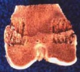 Illustration 13 for Percutaneous Epiphysiodesis: Precisely Closing the Third of the Physis