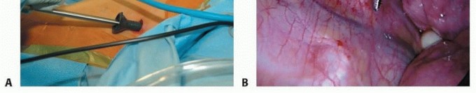 Illustration 10 for Anterior Interbody Arthrodesis for Scoliosis: What You Need to Know