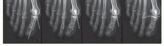 Illustration 2 for Mastering the Biplanar Distal Chevron for Effective Bunion Surgery