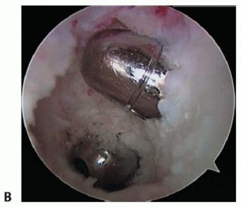 Illustration 17 for Posterior Cruciate Ligament Surgery: Regain Knee Strength & Stability
