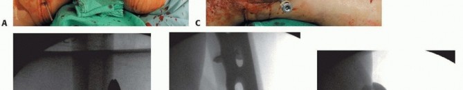Illustration 56 for Repairing Distal Femur Fractures: Open Reduction & Internal Fixation