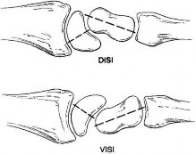 صورة طبية: دليل الأستاذ الدكتور محمد هطيف الشامل لأمراض وإصابات اليد والمعصم في صنعاء