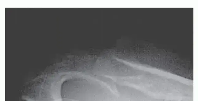 صورة توضيحية لـ الكتف المتصادم: دليلك الشامل لعلاج احتكاك الكتف بالمنظار والتعافي الكامل مع الدكتور محمد هطيف