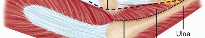 Illustration 25 for Radial Head & Neck Fractures: Mastering ORIF for Best Results
