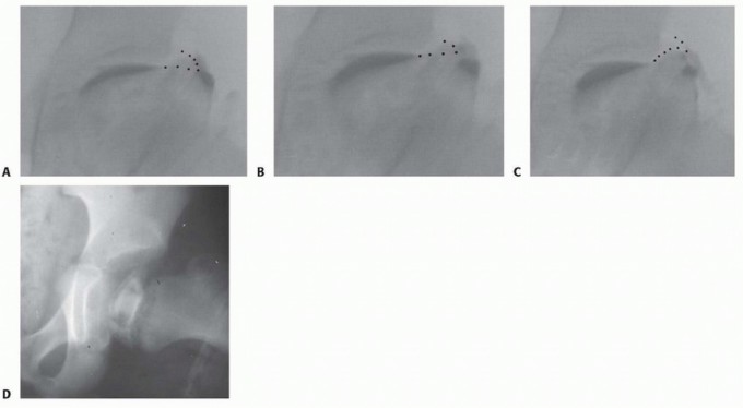 Illustration 7 for Labral Support Shelf Procedure: Preventing Perthes Deformity