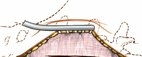 Illustration 7 for Mastering the Spine Posterior Approach: Surgical Essentials