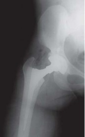 Illustration 37 for Mastering Hip Arthroplasty: Its Evolution and Design Unveiled