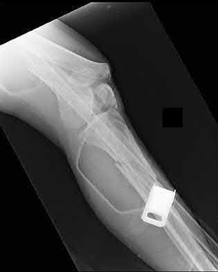 Illustration 136 for OrthoCash: Trauma MCQs & Cases for a yearold woman