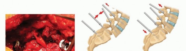 Illustration 17 for Mastering High-Grade Spondylolisthesis: Posterolateral and Interbody Fusion