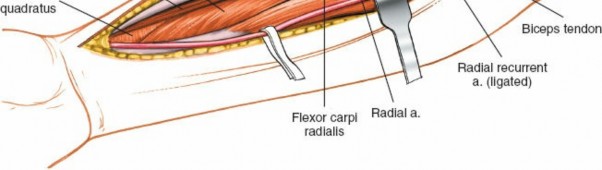 Illustration 11 for Radius Anterior Approach: Safe Nerve Protection & Complete Exposure