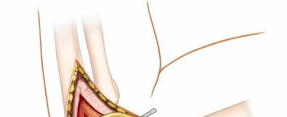 Illustration 48 for Mastering Elbow Approaches: Applied Surgical Anatomy for Precision