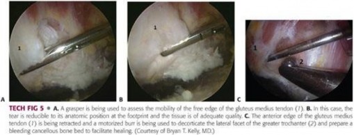 Illustration 130 for Periarticular Arthroscopy: Addressing Medius & Minimus Tears