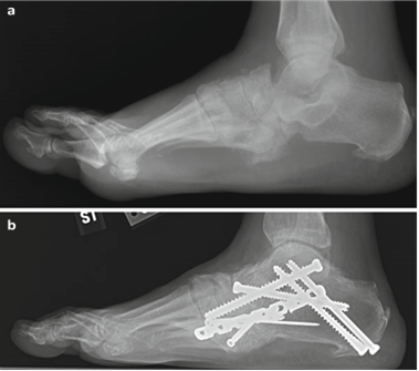 Illustration 124 for First Metatarsal Surgery: Expert Solutions for Foot & Ankle Pain