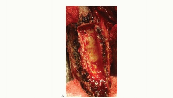 Illustration 14 for Restore Vital Function: Surgery for Type II Humeral Metastasis