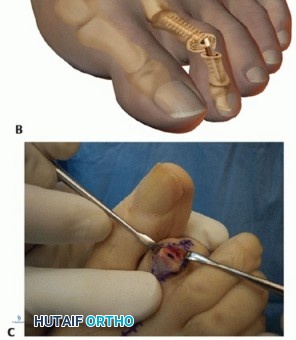 Illustration 34 for Hammer Toe Correction: Understanding the Extensor Digitorum Longus