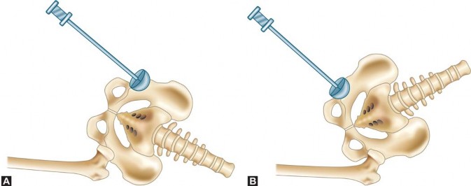 Illustration 24 for Unlock Movement: Arthroplasty for Bony Ankylosis Solutions