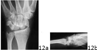 Unlock Upper Extremity Ortho MCQs: Get the Response to Your Question