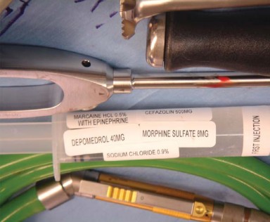 Illustration 30 for Posterolateral Surgical Approaches: Achieve Optimal Hip Replacement