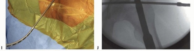 Illustration 40 for Emergency Fixation of the Pelvis: Control Bleeding & Restore Stability