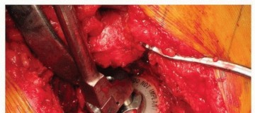 Illustration 7 for Uncemented Acetabular Revision: Optimizing Hemispherical Cup Use