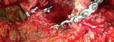 Illustration 27 for Management of Periprosthetic Fractures: An Expert Surgical Guide