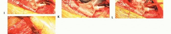 Illustration 19 for Revision Arthroplasty with Acetabular Bone Loss: The Antiprotrusio Cage