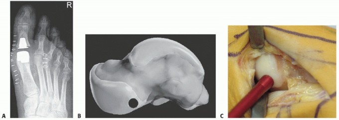 Illustration 2 for Mastering Extensive Plantar Release for Hallux Rigidus