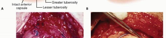 Illustration 24 for Subscapularis & Teres Rotator Cuff Repair: Advanced Techniques