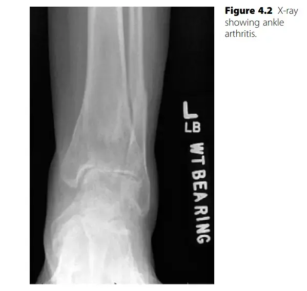صورة توضيحية لـ خشونة الكاحل: الأسباب، الأعراض، والعلاج الشامل في اليمن