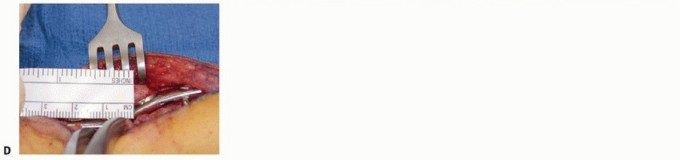 Illustration 10 for Distal Tibial Osteotomy: Fixing Varus & Valgus Ankle Alignment