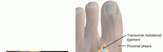 Bunion Correction: Mastering Medial Joint Capsule & Osteotomy