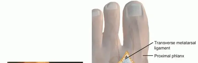 صورة توضيحية لـ عملية تصحيح ورم إبهام القدم الأروح (الوكعة): دليل شامل لاستعادة راحة قدميك مع الأستاذ الدكتور محمد هطيف