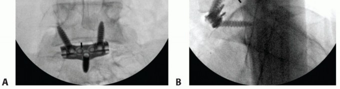 Illustration 13 for Anterior Lumbar Interbody: Fusion, Disc Replacement & Pain Relief