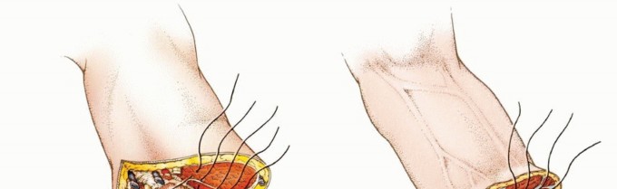 Illustration 23 for Above-Elbow & Below-Elbow Amputations: When & Why They're Needed