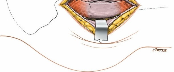 Illustration 134 for Unlocking Every Aspect of the Hip's Surgical Approaches