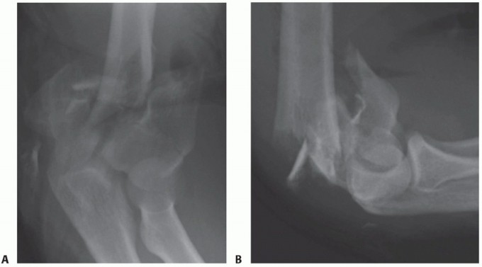 Illustration 4 for Distal Humeral Fractures: When Is Elbow Replacement the Best Option?