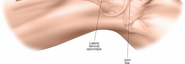 Illustration 52 for Optimal Femoral Approaches: Mastering the Lateral Intermuscular Septum