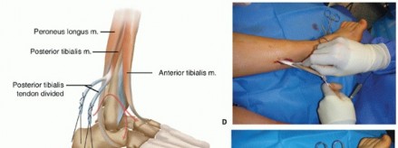 Illustration 17 for How Achilles Tendon Lengthening Fixes Equinocavovarus Foot