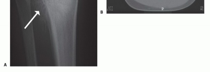 Illustration 10 for Tackling Complex Tumors of the Proximal Tibia: Limb-Sparing Solutions