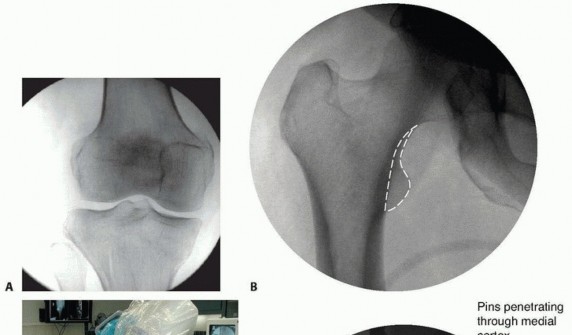 Illustration 35 for Repairing Distal Femur Fractures: Open Reduction & Internal Fixation