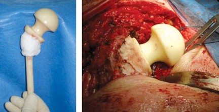Illustration 13 for Optimizing Outcomes: Two Stage Revision for Infected Total Hip Replacement
