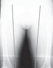 Illustration 12 for Guide Pin Assembly: Key to Flawless Upper Tibial Osteotomy