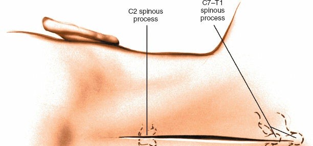 Illustration 169 for Approach to the Lumbar Spine: Mastering Techniques & Anatomy