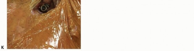 Illustration 42 for Emergency Fixation of the Pelvis: Control Bleeding & Restore Stability