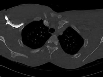Illustration 45 for OrthoCash: Trauma MCQs & Cases for a yearold woman