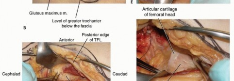 Illustration 16 for Is a Sliding Hip Screw Best for Your Femoral Neck Fracture?