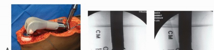 Illustration 29 for Distal Femoral Replacement: Key to Modern Limb Salvage