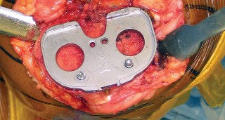 Illustration 9 for Monoblock Total Knee: When to Use & What to Avoid