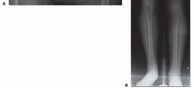Illustration 16 for Special THA Techniques for Severe Deformities Around the Hip