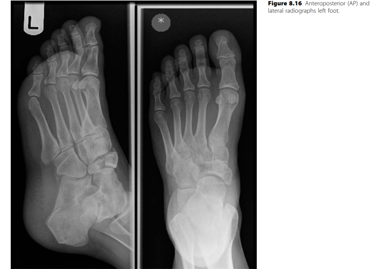 Mastering Body of Navicular Fractures: Clinical Case Guide